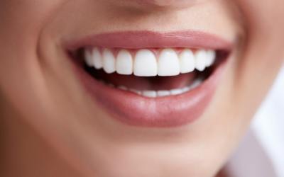 Cât durează efectele albirii dentare?